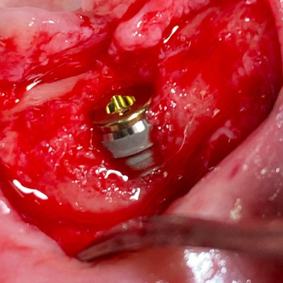 Zahnloser Kiefer Implantat eingesetzt