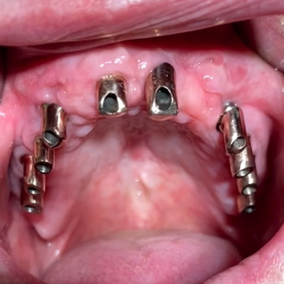 Zahnloser Kiefer 10 Implantate