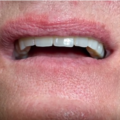 Zahnloser Kiefer Ergebnis